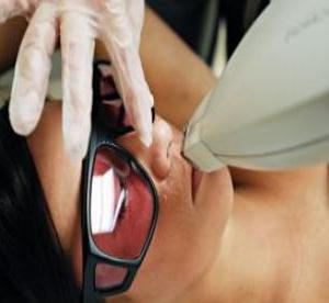 Лазерна епіляція верхньої губи: ефективна процедура в боротьбі з надокучливими волосками