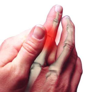 Артрит пальців рук: лікування, причини, симптоми