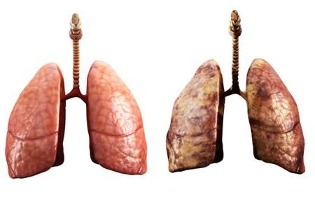 Як лікувати запалення легенів