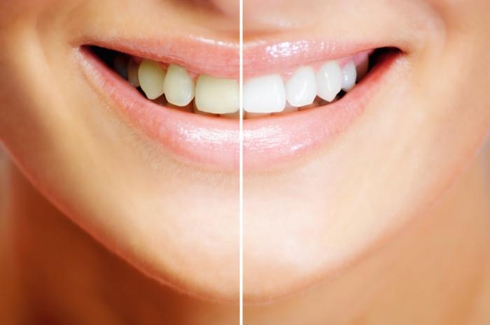Професійне відбілювання зубів: способи, протипоказання